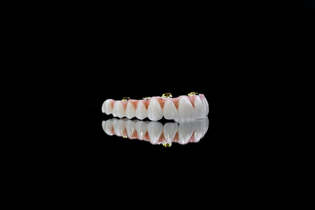 Arcadă protetică definitivă pe implanturi — vedere laterală cu reflexie