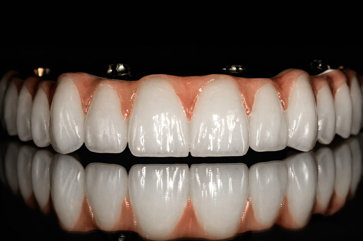 Arcadă superioară pe implanturi dentare — vedere frontală cu detaliu ceramic